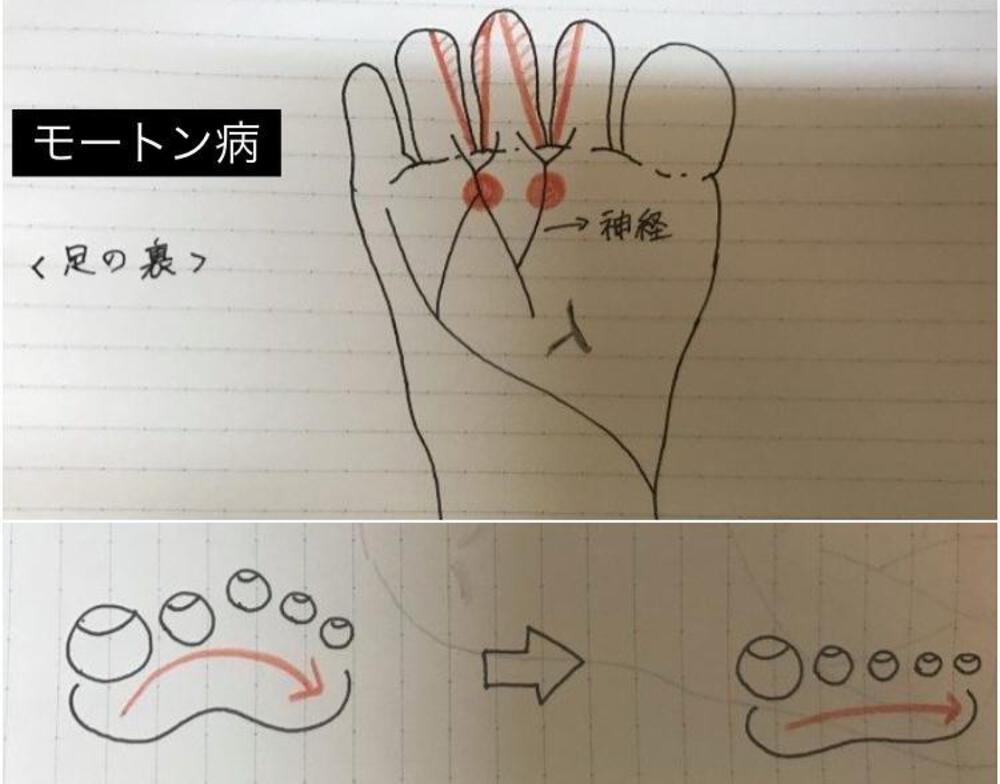 【モートン病勉強してDo not run】
午後から雨でSSR中止☔
ってことで、たなかやさんが
悩んでいるモートン病を調べてみる。
原因はよく分かってないけど
靴が合っていない、扁平足、
横アーチの低下、硬い地面での
ランニングと言われています🏃
症状としては、人差し指と中指、
もしくは中指と薬指の間や
人差し指や中指、薬指の付け根に
強い痛みや腫れが出ます🔥
対処法としては安静が一番だけど、
ランナーだとなかなかできないよね💦
モートン病のランナーの足を見ると
横アーチが落ちていることが多いから
インソールやテーピングでアーチを作るか、
痛い部位の下に専用パットを当てるのが
良いかと🙆
あと、たなかやさんのアウトソールを
見ると母指球側が大きくすり減っていたので
母指球側の接地時間が長いのかなと🤔
と、いろいろ書いてみたけど
やっぱり痛いときは長期休足ですね🦶